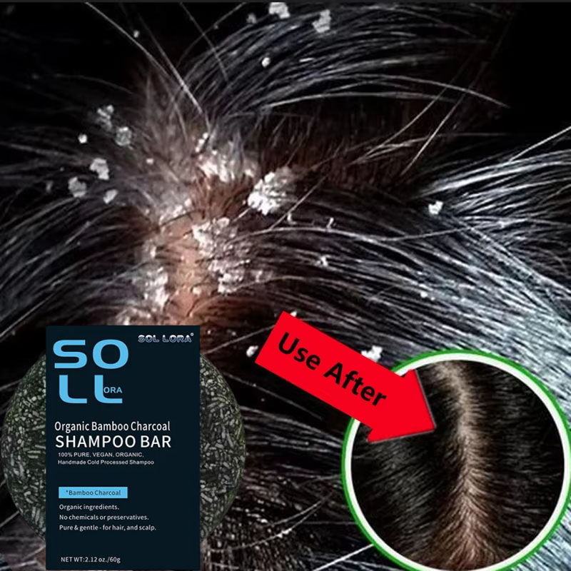Castor Oil Soap - Fast Anti Dandruff Hair Treatment สบู่อาการคันซ่อมทําความสะอาดหนังศีรษะ